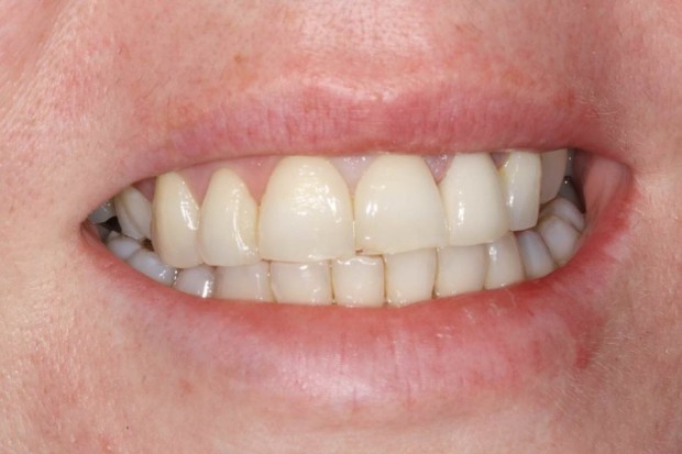 Teeth Whitening After - Appletree Dental Care