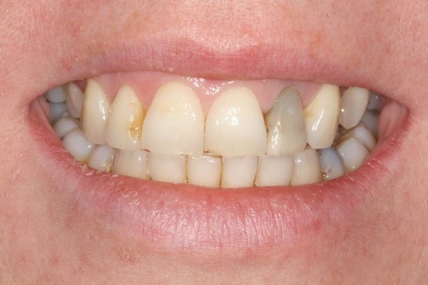 teeth whitening before - Appletree Dental Care