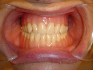 dentures secured