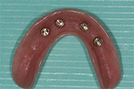 Denture Implants