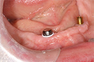 Denture Implants