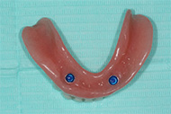 Denture Implants