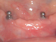 Implants close up