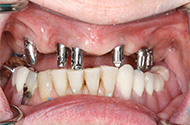 Jaw Implant