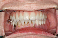 Jaw Implant