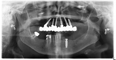 Jaw Implant