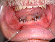 implants for securing denture