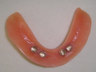 overdenture for securing on implants