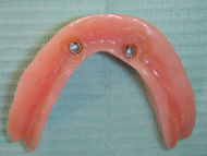 overdenture for securing on implants