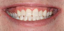 Veneers to disguise small rotated front teeth After