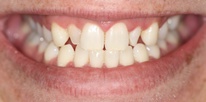 Veneers to disguise small rotated front teeth Before