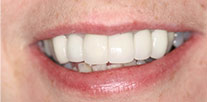 Front teeth restored with all-ceramic Crowns After