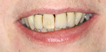 Front teeth restored with all-ceramic Crowns Before