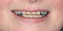 Severe tooth wear restored with all-ceramic crowns Before