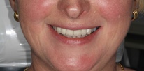 Severe tooth wear restored with all-ceramic crowns After
