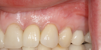Implant crowns to upper incisor and canine After