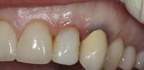 Implant crowns to upper incisor and canine Before