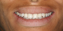 2012 UK Smile Awards winning Case. Best single implants smile After
