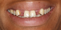2012 UK Smile Awards winning Case. Best single implants smile Before