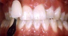 Tooth Whitening After