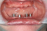 Denture Implants