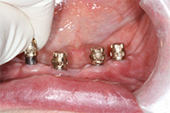 Denture Implants