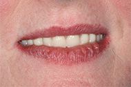 Denture Implants