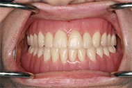 Denture Implants