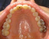 tooth fractured at gum margin
	plus resultant discolouration